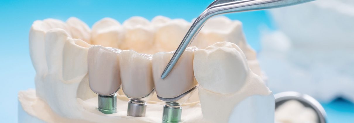A dental model showing three dental implants with artificial teeth being placed using metal tweezers.