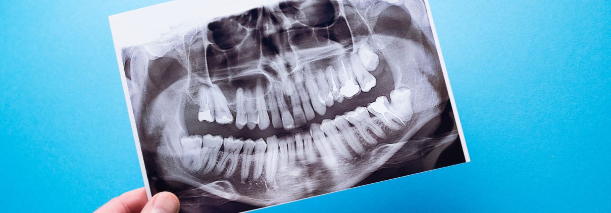 A hand holds a dental X-ray against a blue background, showing a full set of adult teeth, jawbones, and dental work such as fillings and crowns.