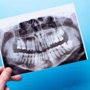 A hand holds a dental X-ray against a blue background, showing a full set of adult teeth, jawbones, and dental work such as fillings and crowns.