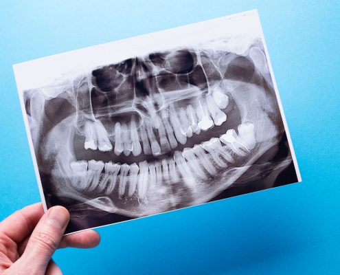 A hand holds a dental X-ray against a blue background, showing a full set of adult teeth, jawbones, and dental work such as fillings and crowns.
